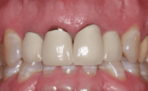 Nguyên nhân răng giả xuất hiện viền đen ở nướu
