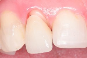 Nguyên nhân răng giả bị tụt lợi