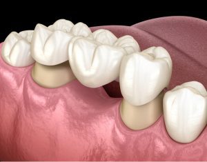 Cầu răng cũ hỏng cần phải làm gì?Nguyên nhân cầu răng hỏng
