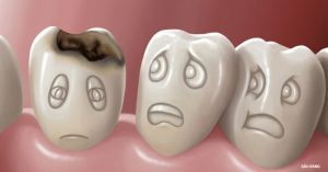 Nguyên nhân,các dấu hiệu sâu răng và cách điều trị sâu răng hiệu quả