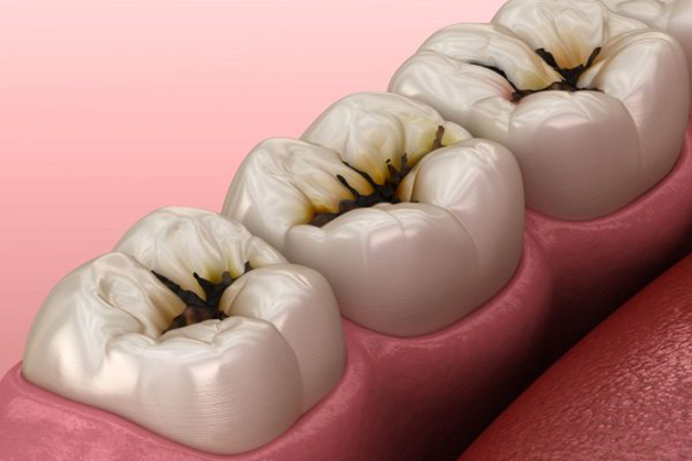 Nguyên nhân,các dấu hiệu sâu răng và cách điều trị sâu răng hiệu quả