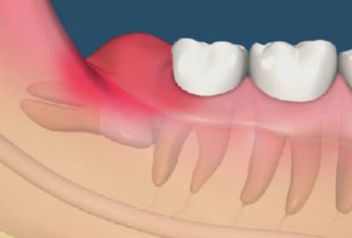 Sưng chân răng cấm do đâu- nguyên nhân và cách xử lý