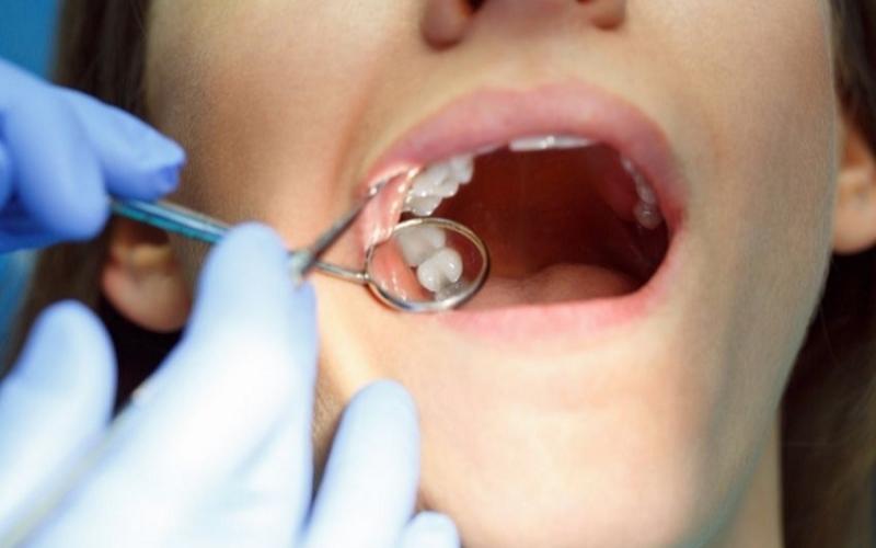 Sau nhổ răng khôn cần phải khâu lại để tránh nhiễm trùng