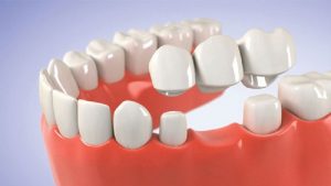Trồng răng implant có niềng răng được không? – Răng giả có niềng được không?