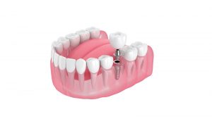 Phương pháp làm răng Implant