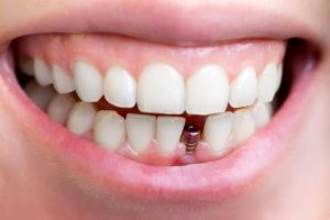 Răng cố định là chiếc răng có cấu tạo gồm phần lõi và phần răng ngoài, được gắn chặt trên trụ răng
