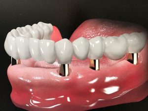 Khi nào nên gắn răng tạm và răng giả cố định?