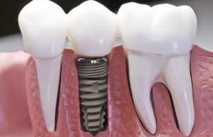 Cách khắc phục răng giả bị lỏng