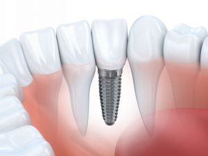 Kỹ thuật trồng răng implant phù hợp với những ai?