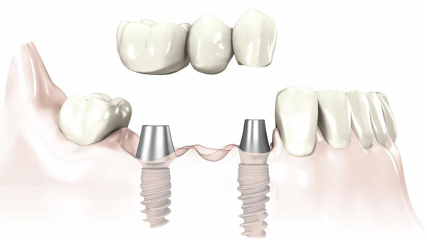 Yếu tố quyết định trồng răng implant có đau không