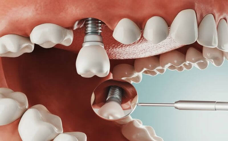 Sau phẫu thuật trồng răng implant có đau không