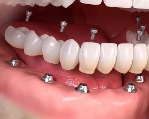 Trồng răng implant sở hữu nhiều ưu điểm vượt trội hơn so với răng sứ