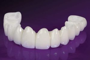 Cầu răng cũ sứ hỏng cần phải làm gì?Nguyên nhân cầu răng hỏng