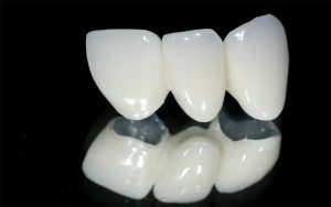 Răng sứ titan là loại răng sứ có cấu tạo 2 phần: phần lõi kim loại bên trong và bên ngoài phủ lớp sứ nguyên chất
