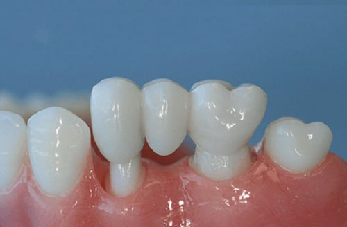 Cầu răng sứ là gì?Khi nào cần thiết làm cầu răng sứ?
