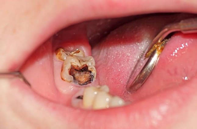 Sâu răng nặng gây viêm tủy răng