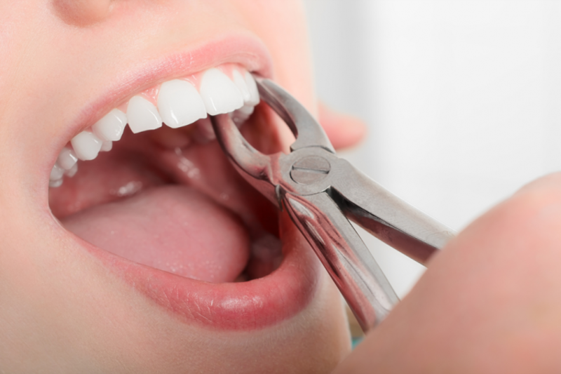 Giải quyết đau răng khôn hàm trên thế nào?