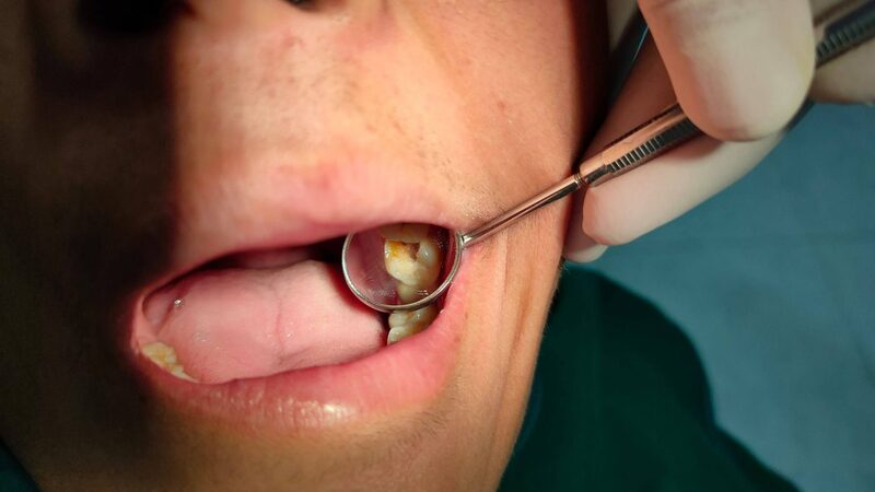 Lấy tủy răng có ảnh hưởng gì đến sức khỏe?