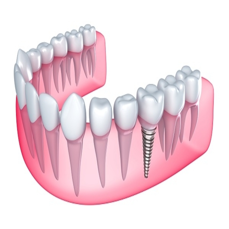 Trồng răng Implant 