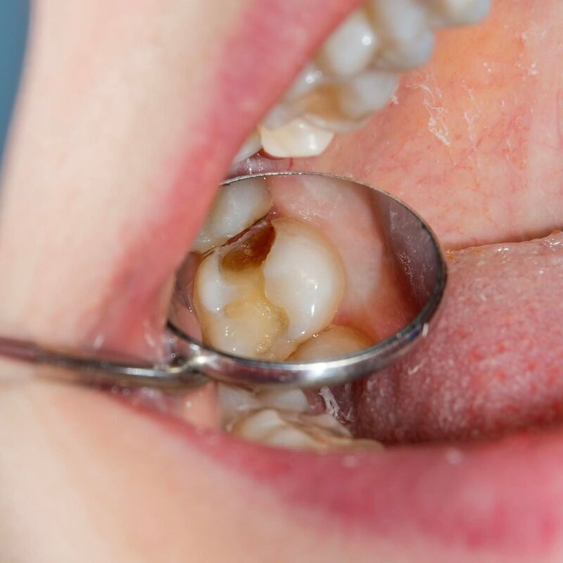 Bước 4: Tiến hành quy trình điều trị tủy răng