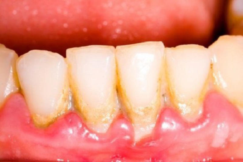 Cách phòng ngừa viêm lợi răng hiệu quả tại nhà