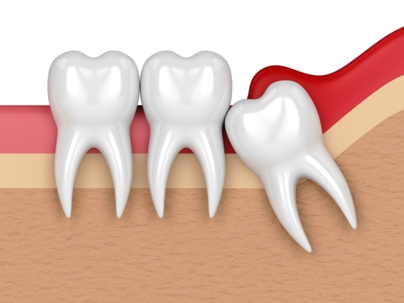 Một số vấn đề liên quan đến răng khôn