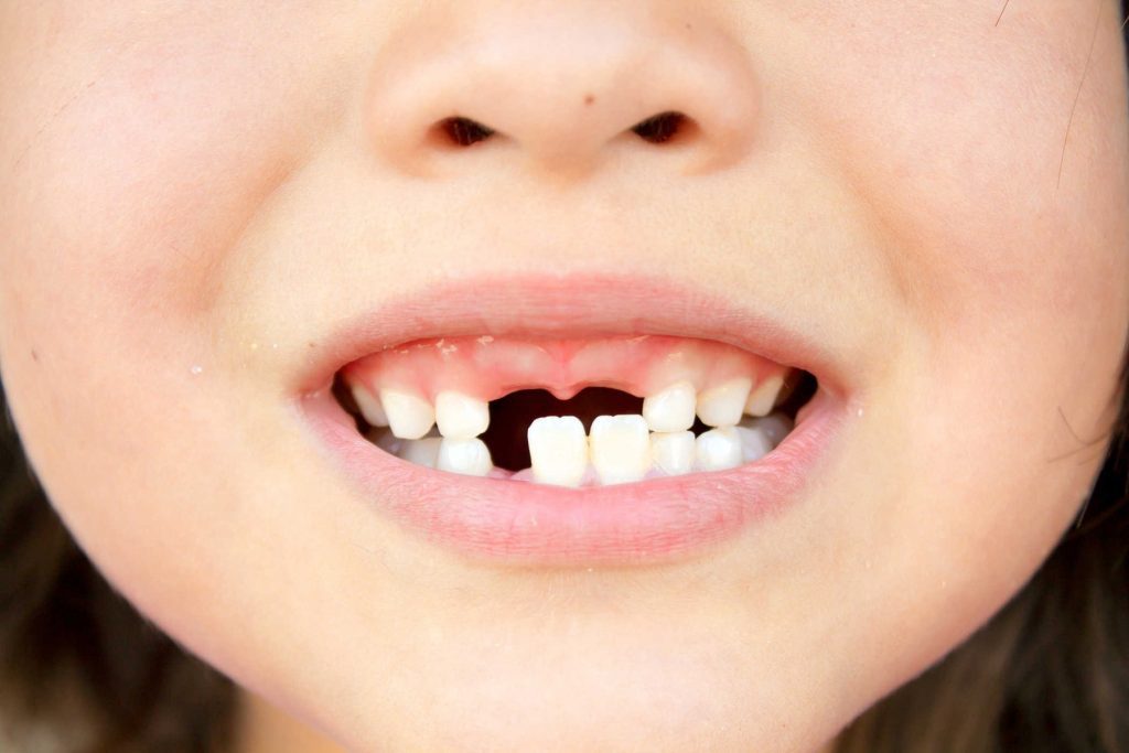 Gãy răng ảnh hưởng lớn trong việc ăn uống 