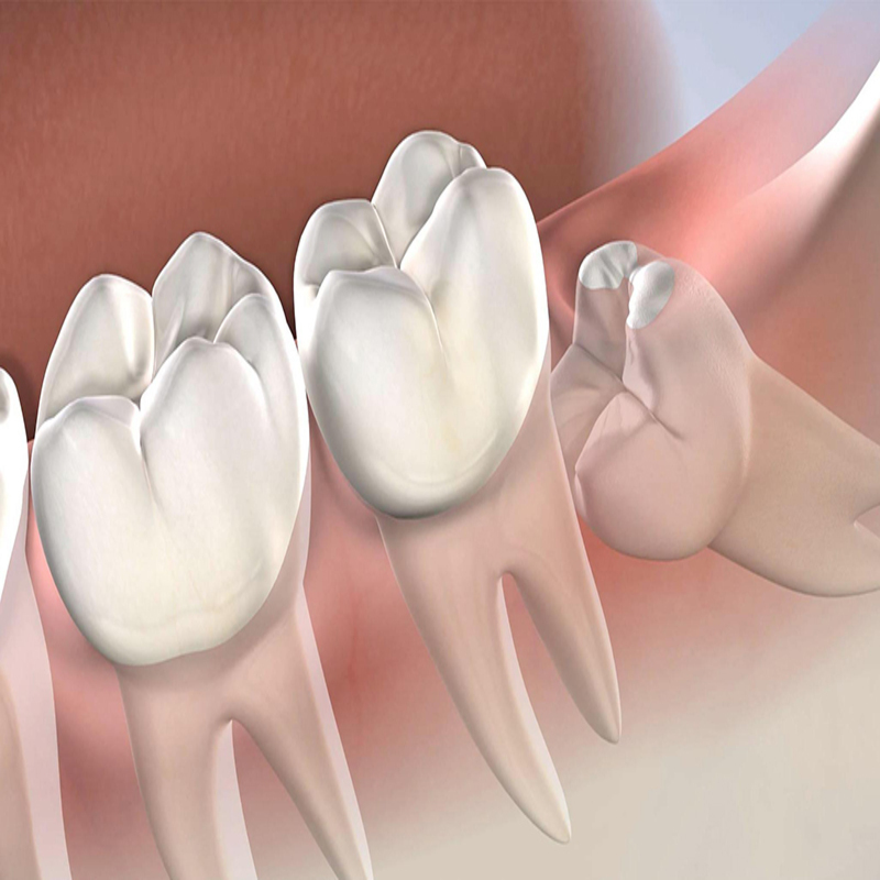 Một số trường hợp điển hình của răng khôn mọc lệch ra má 