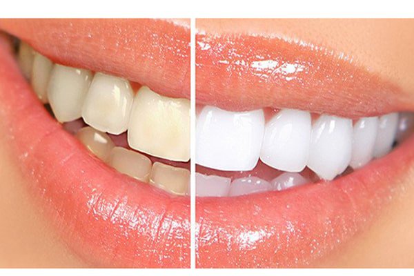  Nguyên nhân nào khiến răng đổi màu và có màu xỉn vàng? 