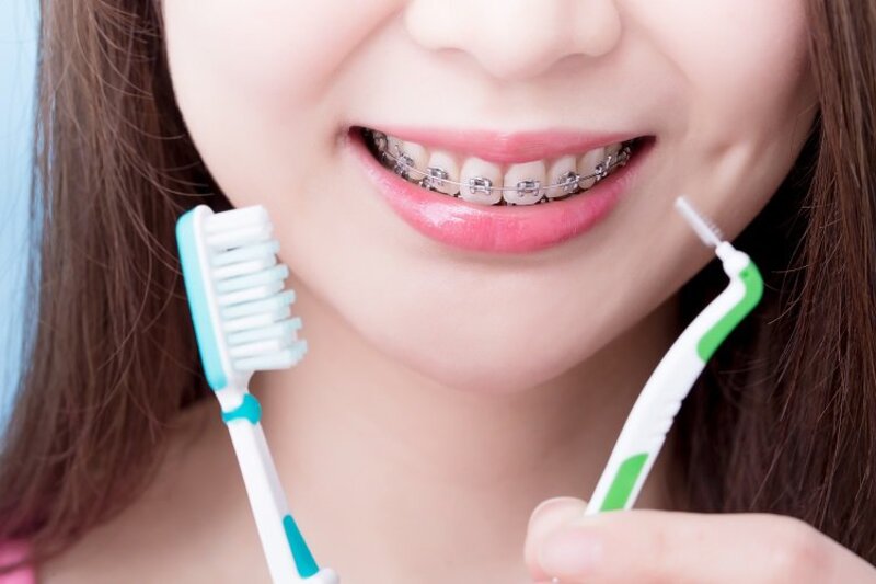 Cách chăm sóc răng miệng trong thời gian niềng răng 