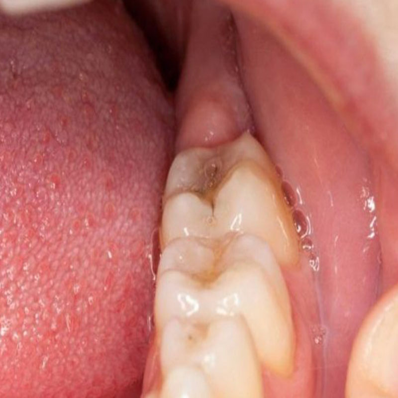 Dấu hiệu giúp nhận biết tình trạng đau răng khôn