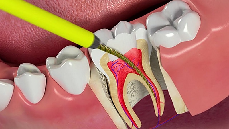 Quy trình lấy tủy răng có đau không?