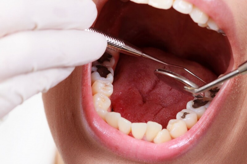  Cách trị đau răng tại nhà nhanh chóng mà cực hiệu quả 