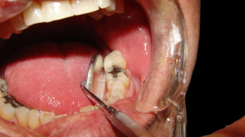 Quá trình lấy tủy răng diễn ra như thế nào?