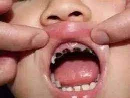 trẻ 1 tuổi bị sâu răng