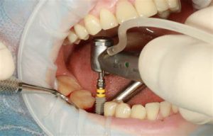 Sau khi nhổ răng bao lâu thì trồng implant là tốt nhất?