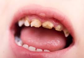 Cách điều trị sâu răng cho trẻ em 2 tuổi an toàn, hiệu quả