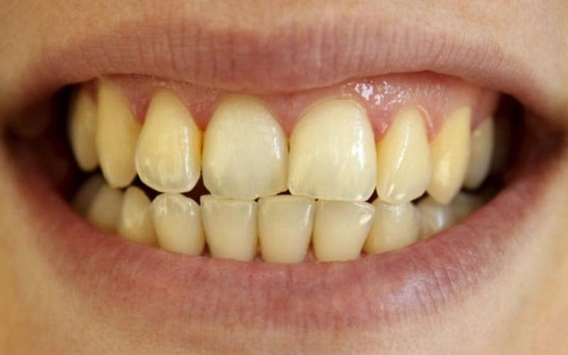 8 thói quen sai lầm khiến răng ố vàng mà bạn nên tránh