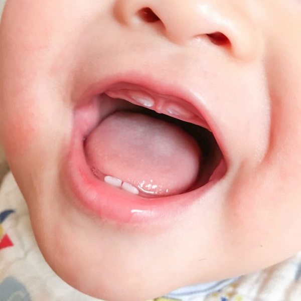 Nướu răng trẻ có đốm trắng là hình ảnh chiếc răng bắt đầu nhú