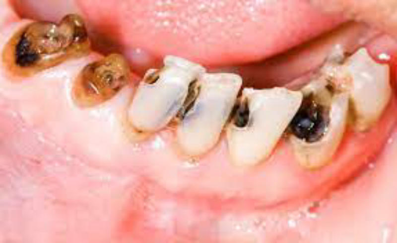 Bị sâu răng là gì