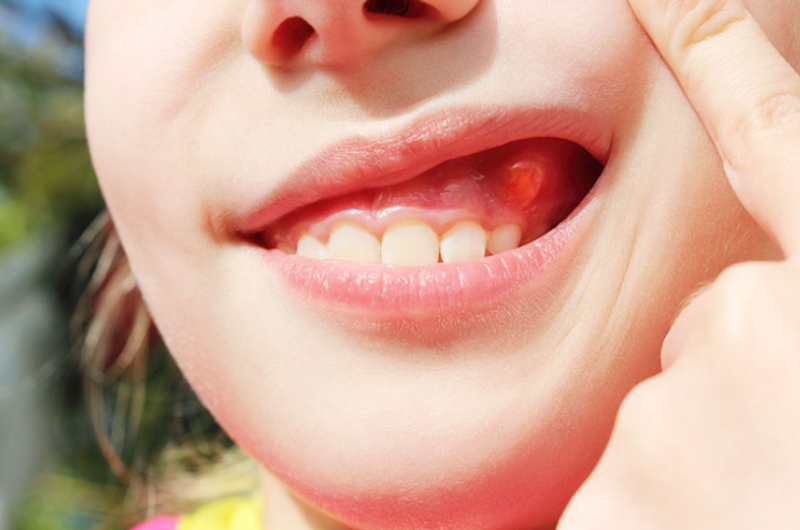 Bị sưng nướu răng có là triệu chứng bệnh nguy hiểm.