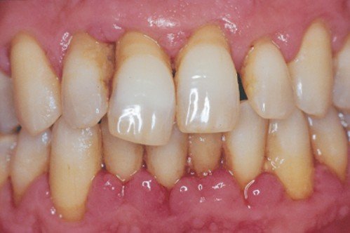 Các bệnh lý ở vùng quanh răng 