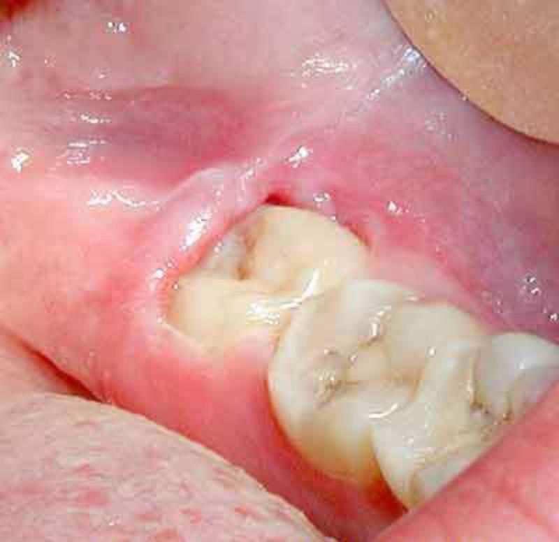 Các biến chứng nguy hiểm của viêm lợi răng