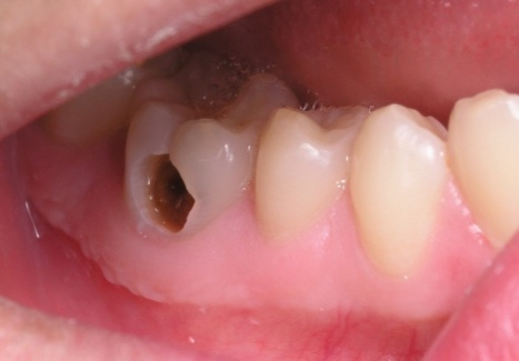 Cách chữa nhức răng bằng dùng thuốc đau răng