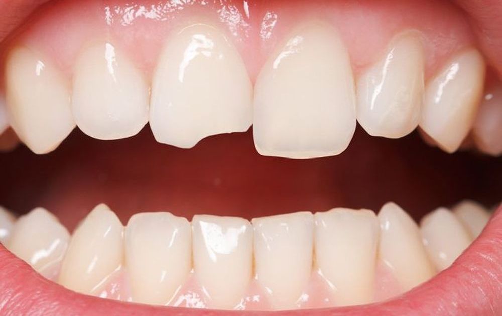 Cách khắc phục mẻ răng