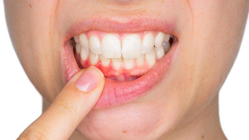 Cách trị dứt điểm sưng lợi răng hàm tại nha khoa.