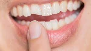 Cách xử lý khi răng bị mẻ