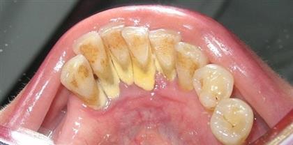 Cao răng hình thành thế nào