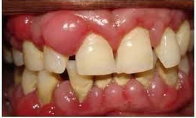 Dấu hiệu của bệnh viêm chân răng có mủ