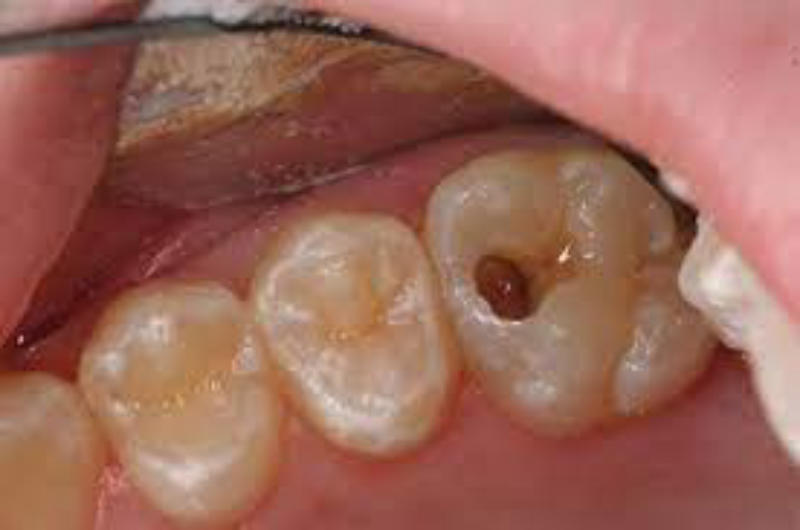 Dấu hiệu nhận biết bị sâu răng